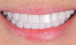 Thumbnail control image for Close-up of bright white teeth with healthy pink lips smiling naturally.