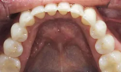 Thumbnail control image for Close-up view of upper teeth and palate showing natural teeth alignment and dental arch structure.