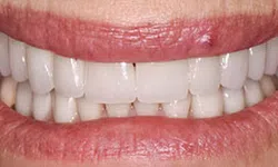 Thumbnail control image for Close-up of a smile with slightly parted lips showing clean, well-aligned white teeth and natural lip texture.
