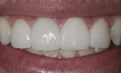 Thumbnail control image for Close-up of a smiling mouth showing white, healthy upper front teeth and pink gums.