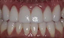 Thumbnail control image for Close-up of clean, well-aligned human teeth with healthy gums and natural shine under bright light.