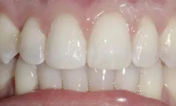Thumbnail control image for Close-up of white, healthy human teeth and gums with natural alignment and shine under bright light.