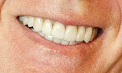 Thumbnail control image for Close-up of a smiling mouth showing clean, white teeth and healthy lips with natural skin texture.