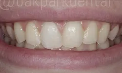 Thumbnail control image for Close-up of healthy upper and lower teeth with slight overlap and natural color in a smiling mouth.