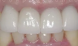 Thumbnail control image for Close-up of upper front teeth showing dental crowns or veneers with healthy gums and natural teeth.