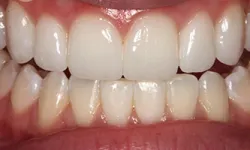 Thumbnail control image for Close-up of healthy human teeth and gums showing clean, white teeth and natural pink gums