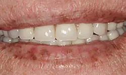 Thumbnail control image for Close-up of smiling lips showing white teeth and aged skin with visible wrinkles and spots.