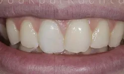 Thumbnail control image for Close-up of a smile showing slightly misaligned upper front teeth and natural lips.