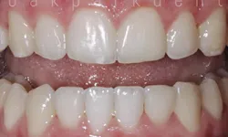 Thumbnail control image for Close-up of healthy, clean human teeth and gums showing natural dental alignment and color.