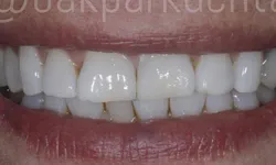 Thumbnail control image for Close-up of a bright smile showing clean, white, evenly spaced teeth with natural lips.