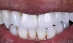 Thumbnail control image for Close-up of a bright smile showing clean, white teeth and healthy pink lips.