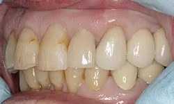 Thumbnail control image for Close-up of stained and worn human teeth with visible plaque and gum tissue, held open by dental gloves.