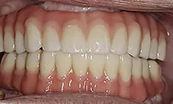 Thumbnail control image for Close-up of a healthy set of natural teeth and gums with no visible dental issues.