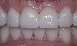 Thumbnail control image for Close-up of clean, healthy upper and lower teeth with smooth gums and a white, even smile.