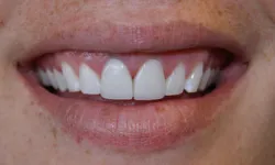 Thumbnail control image for Close-up of a smiling mouth with straight, white teeth and natural lips.