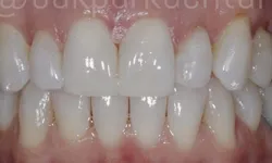 Thumbnail control image for Close-up of healthy, clean human teeth showing upper and lower front teeth with pink gums.