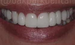 Thumbnail control image for Close-up of a bright white smile with healthy teeth and natural lips, showcasing dental care.