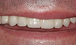 Thumbnail control image for Close-up of a person's mouth showing upper teeth with dental crowns and natural gums.