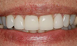 Thumbnail control image for Close-up of a smiling mouth showing white upper dental crowns with natural lips and skin texture.