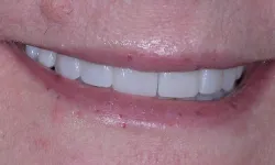 Thumbnail control image for Close-up of a smiling mouth showing clean white teeth and slightly dry lips with minor blemishes.