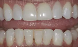 Thumbnail control image for Close-up of a person's mouth showing upper and lower teeth with a slight gap between the central incisors.