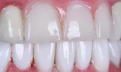 Thumbnail control image for Close-up of clean, white upper and lower front teeth with healthy pink gums and shiny enamel.