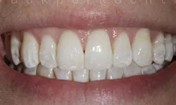 Thumbnail control image for Close-up of a smiling mouth showing teeth with white spot discoloration and healthy pink gums