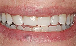 Thumbnail control image for Close-up of a person's smile showing slightly uneven, stained teeth and visible lips.
