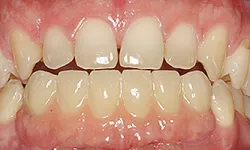 Thumbnail control image for Close-up of human teeth with visible gaps and slight misalignment between upper and lower front teeth.