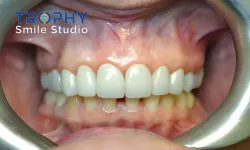 Thumbnail control image for a person's mouth with teeth