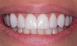 Thumbnail control image for Close-up of a smiling mouth showing clean, well-aligned white teeth and healthy pink gums.