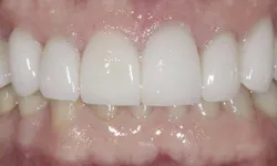 Thumbnail control image for Close-up of a smile showing upper teeth with dental veneers over natural lower teeth.