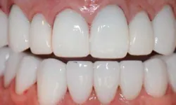 Thumbnail control image for Close-up of a healthy smile showing clean, white teeth with no visible staining or damage on gums.