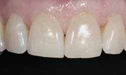 Thumbnail control image for Close-up of upper front teeth showing natural enamel texture and healthy pink gums.