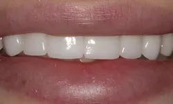 Thumbnail control image for Close-up of a smile showing clean, white, evenly aligned upper front teeth with natural lips.