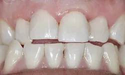 Thumbnail control image for Close-up of human teeth showing gaps and slight misalignment with healthy pink gums visible.