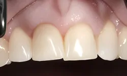 Thumbnail control image for Close-up of upper front teeth showing dental veneers being checked with a dental tool for fit and finish.