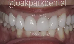 Thumbnail control image for Close-up of a smile showing clean, white dental veneers on upper front teeth.