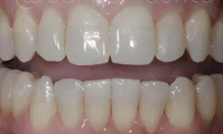 Thumbnail control image for Close-up of upper and lower teeth showing dental alignment and enamel surface details