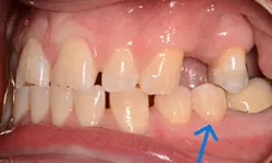 Thumbnail control image for Close-up of a person's upper and lower teeth showing gaps and missing teeth in the upper jaw.