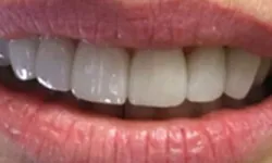 Thumbnail control image for Close-up of a smiling mouth showing straight, white teeth and natural lips.