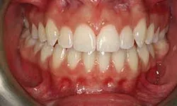 Thumbnail control image for Close-up of human teeth and gums showing dental alignment and oral health condition.