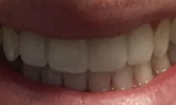 Thumbnail control image for Close-up of a smiling mouth showing clean, healthy white teeth and natural gums.