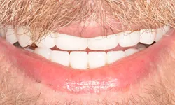 Thumbnail control image for Close-up of a smiling mouth with white teeth, mustache, and light facial hair on fair skin.