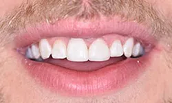 Thumbnail control image for Close-up of a smiling mouth with white teeth and light facial hair on upper lip and chin.