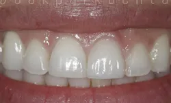 Thumbnail control image for Close-up of a smiling mouth showing clean, white, evenly shaped front teeth and healthy gums
