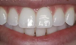 Thumbnail control image for Close-up of a healthy smile showcasing clean, white teeth and natural gums in a bright close-up image