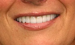 Thumbnail control image for Close-up of a smiling person's mouth showing clean, white teeth and natural lip texture.
