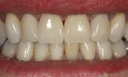 Thumbnail control image for Close-up of a smile showing upper and lower teeth with slight discoloration and natural texture