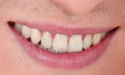 Thumbnail control image for close-up of a person's mouth